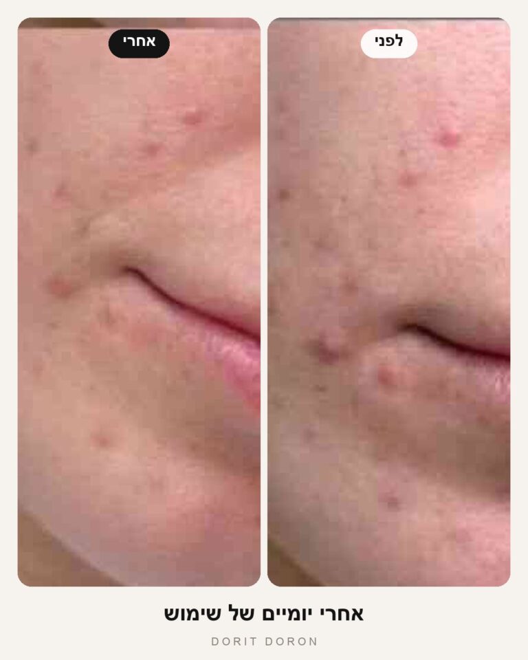 dorit-doron-before-after-skin-01