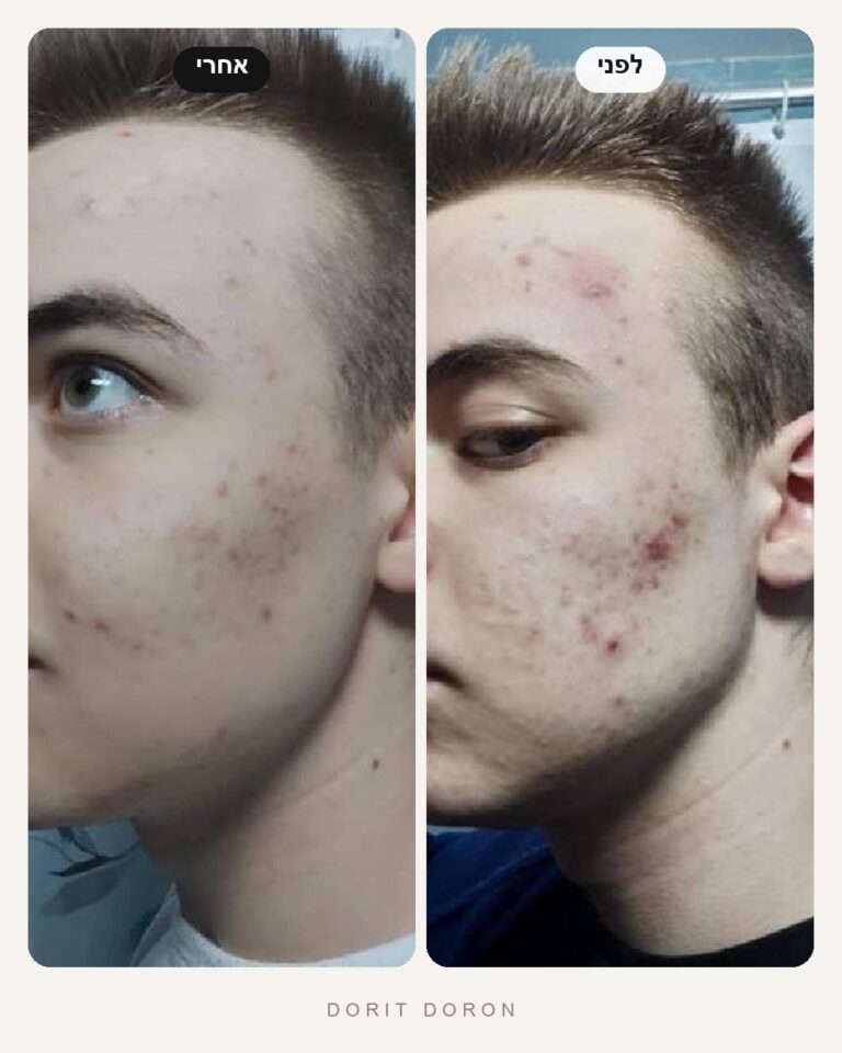 dorit-doron-before-after-skin-03