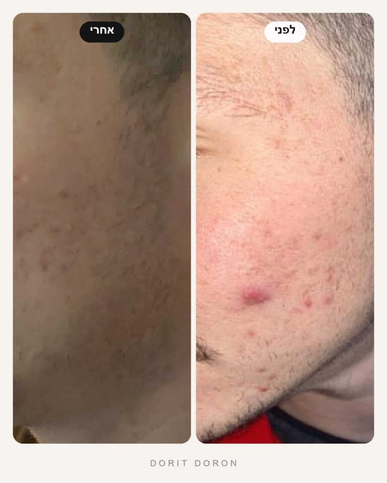 dorit-doron-before-after-skin-04