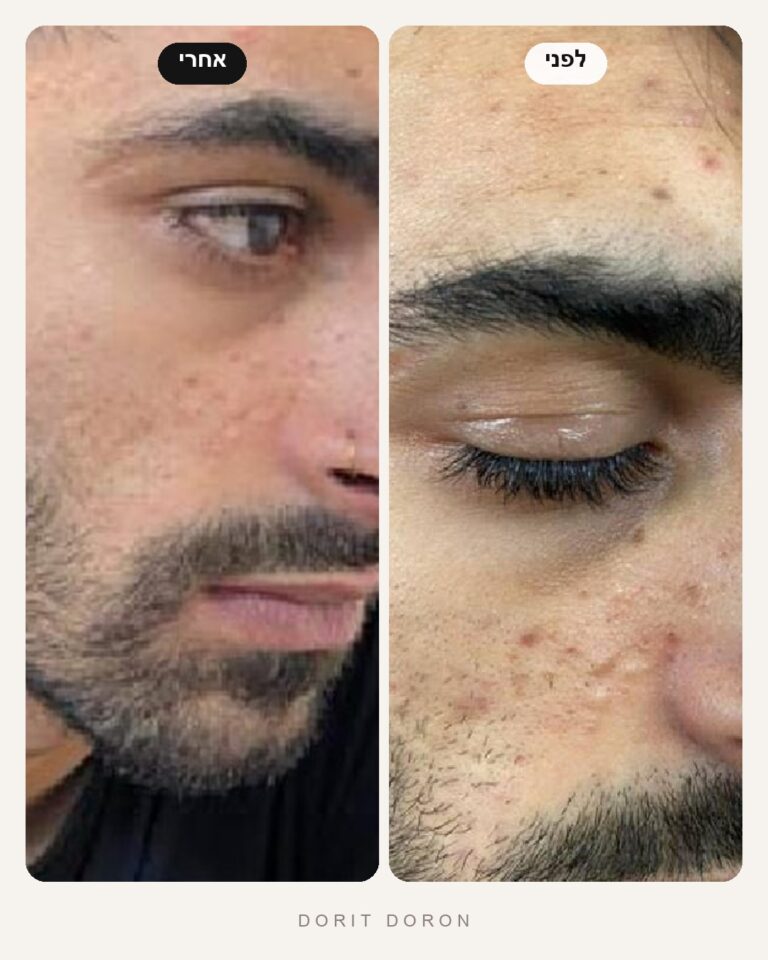 dorit-doron-before-after-skin-05