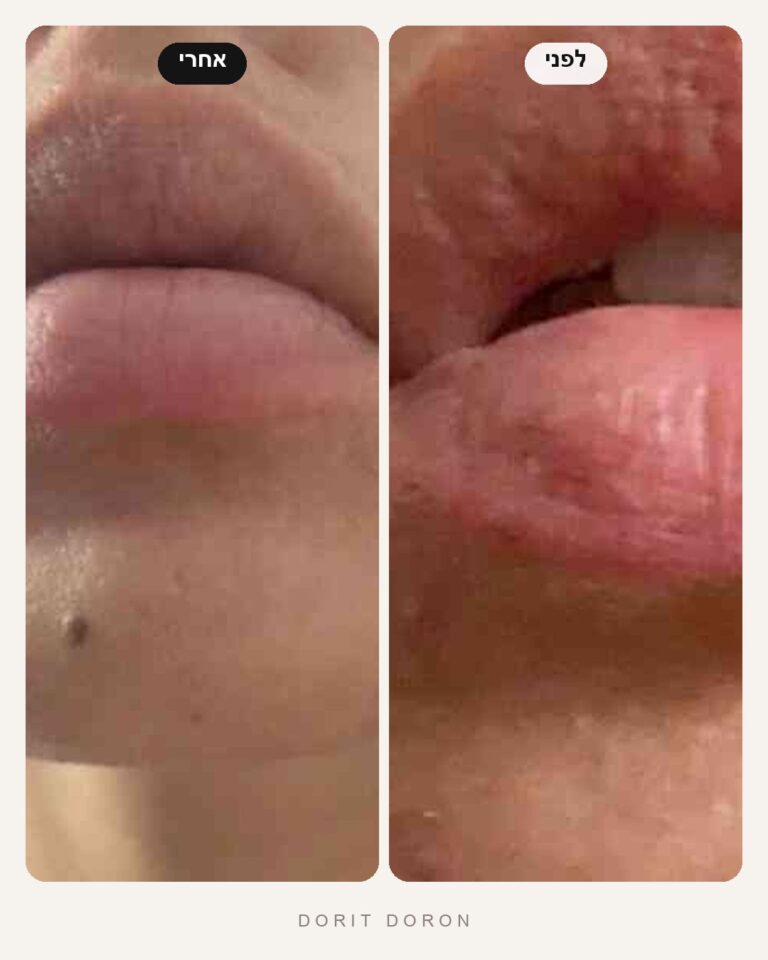 dorit-doron-before-after-skin-06