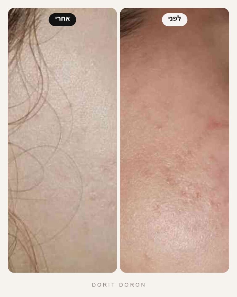dorit-doron-before-after-skin-07