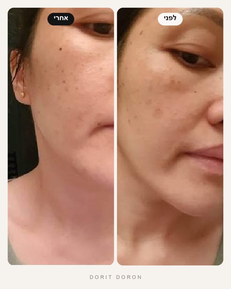dorit-doron-before-after-skin-08