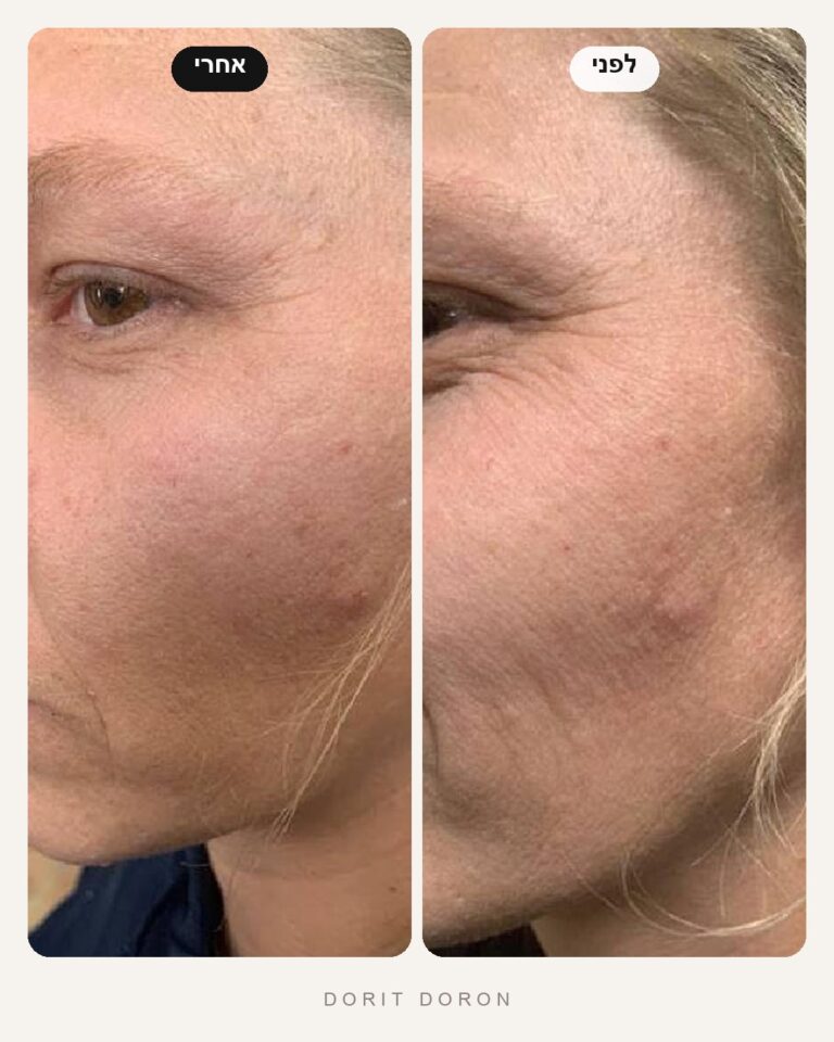 dorit-doron-before-after-skin-09