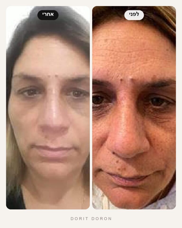 dorit-doron-before-after-skin-10